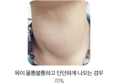 ¸ñÀÌ ¿ïÅüºÒÅüÇÏ°í ´Ü´ÜÇÏ°Ô ³ª¿À´Â °æ¿ì 70%